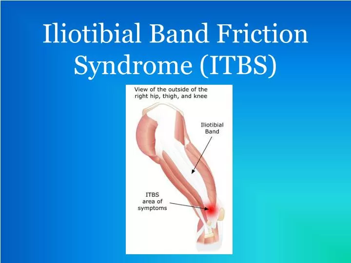 iliotibial band friction syndrome itbs