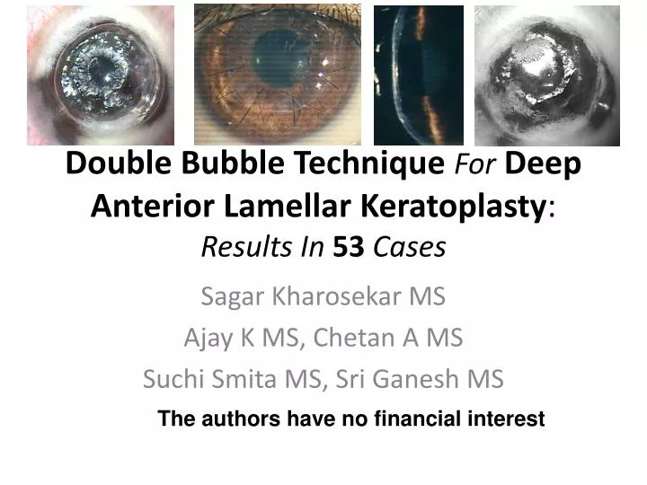 double bubble technique for deep anterior lamellar keratoplasty results in 53 cases