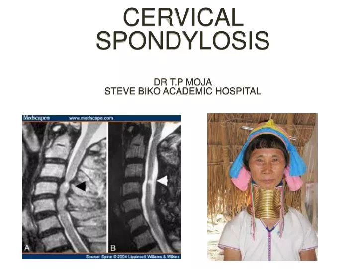 cervical spondylosis dr t p moja steve biko academic hospital