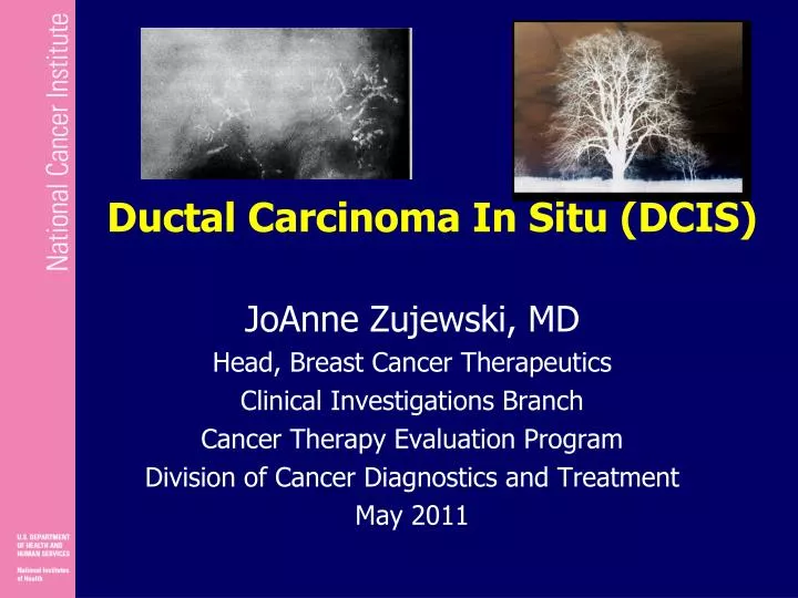 ductal carcinoma in situ dcis