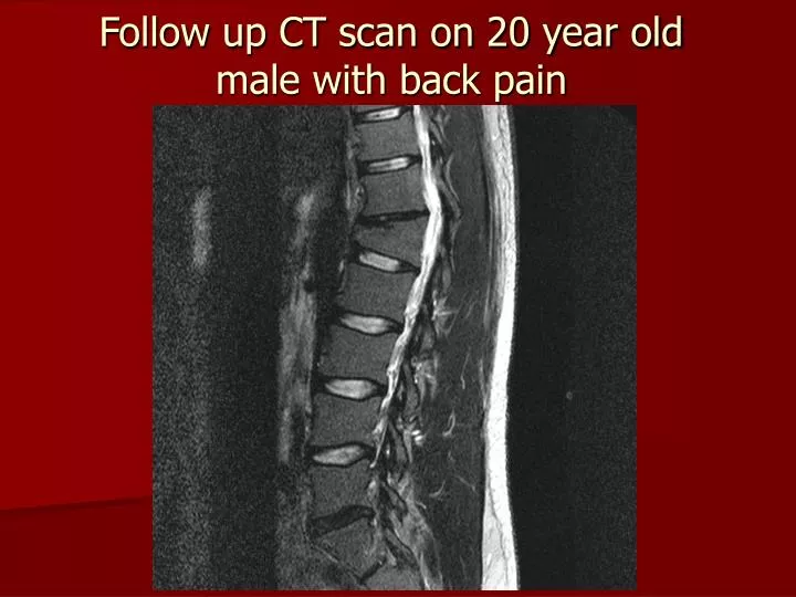 follow up ct scan on 20 year old male with back pain
