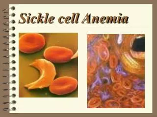 Sickle cell Anemia