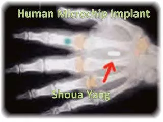 Human Microchip Implant