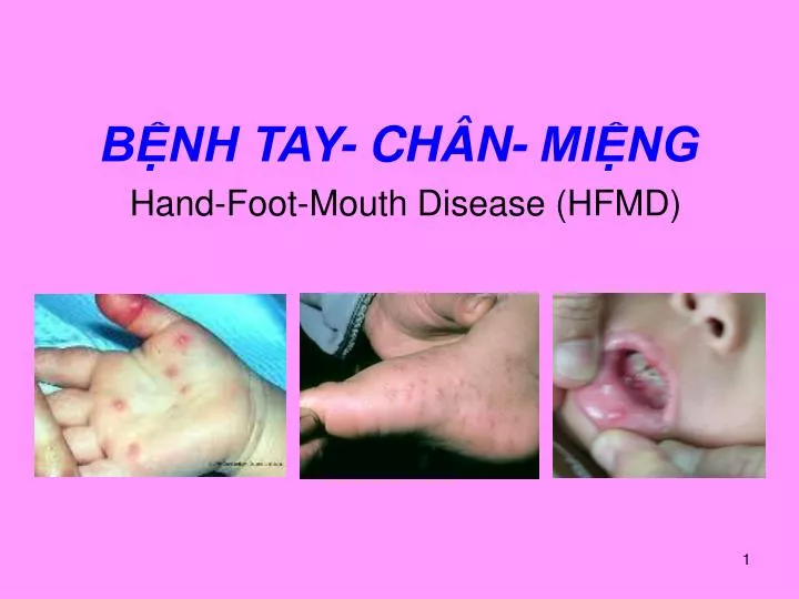 b nh tay ch n mi ng hand foot mouth disease hfmd