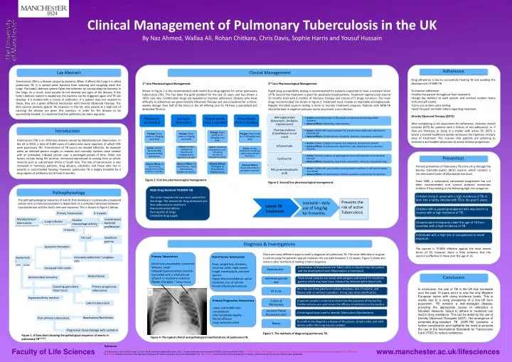 clinical management of pulmonary tuberculosis in the uk
