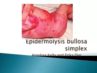 Epidermolysis bullosa simplex