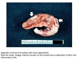 Appendix removed from patient with acute appendicitis.