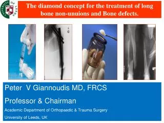 The diamond concept for the treatment of long bone non- unuions and Bone defects .