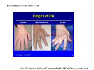 nihseniorhealth/rheumatoidarthritis/faq/faq1c_popup.html