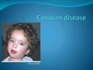 C anavan disease