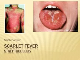Scarlet Fever Streptococcus