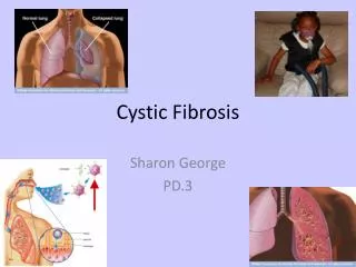 Cystic Fibrosis