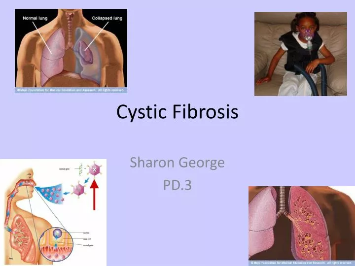 cystic fibrosis