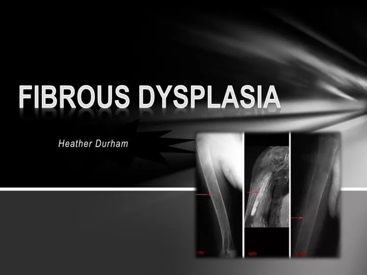 fibrous dysplasia