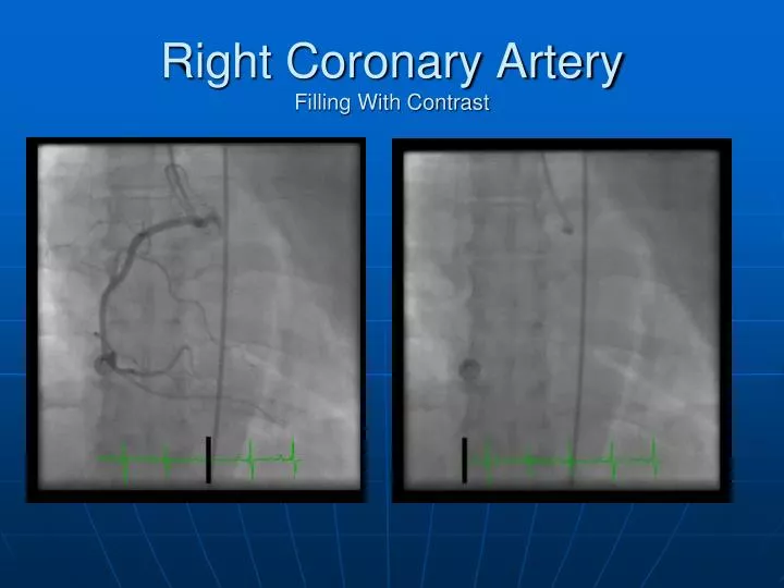 right coronary artery filling with contrast