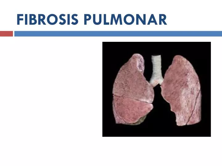 fibrosis pulmonar