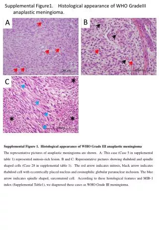 Supplemental Figure1. Histological appearance of WHO GradeIII anaplastic meningioma.
