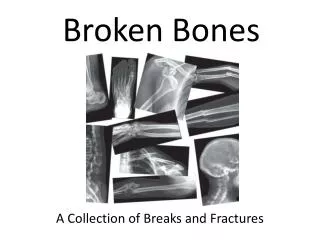 broken bones