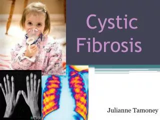 cystic fibrosis