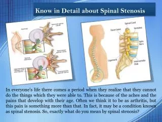 Know in Detail about Spinal Stenosis