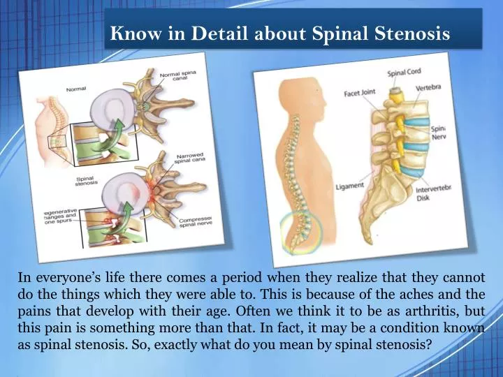 know in detail about spinal stenosis
