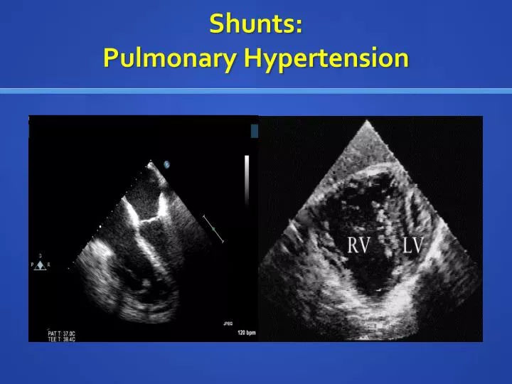 shunts pulmonary hypertension