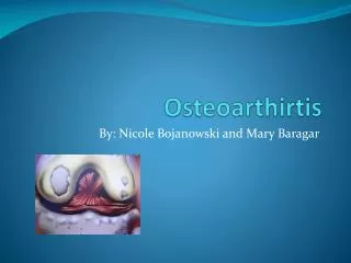 Osteoarthirtis