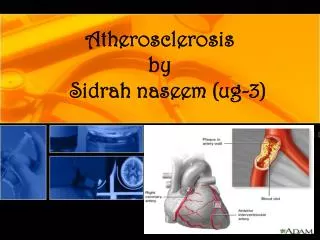 Atherosclerosis by Sidrah naseem (ug-3)