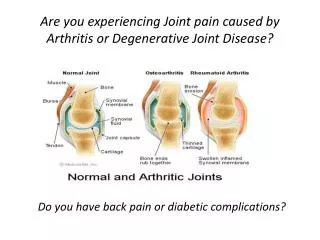 Are you experiencing Joint pain caused by Arthritis or Degenerative Joint Disease?