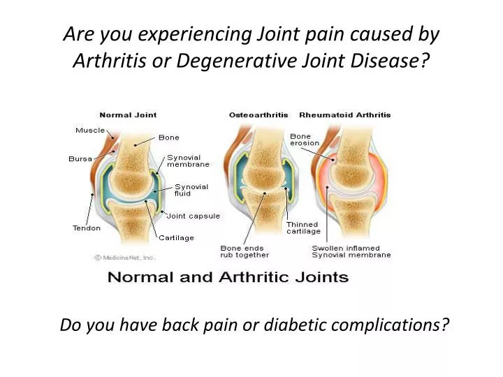 are you experiencing joint pain caused by arthritis or degenerative joint disease