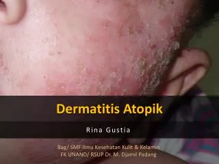 dermatitis atopik