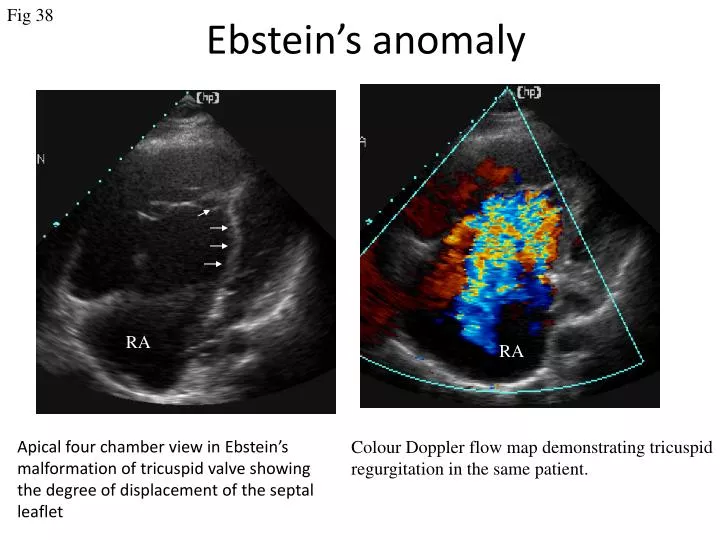 ebstein s anomaly