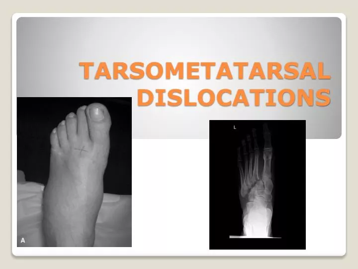tarsometatarsal dislocations