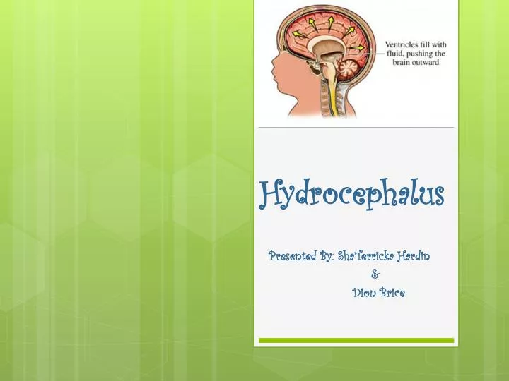 hydrocephalus