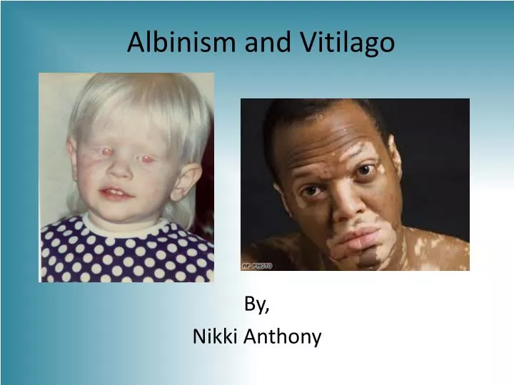 albinism and vitilago