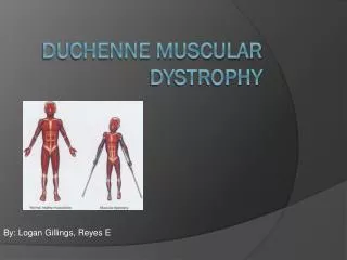 Duchenne Muscular dystrophy