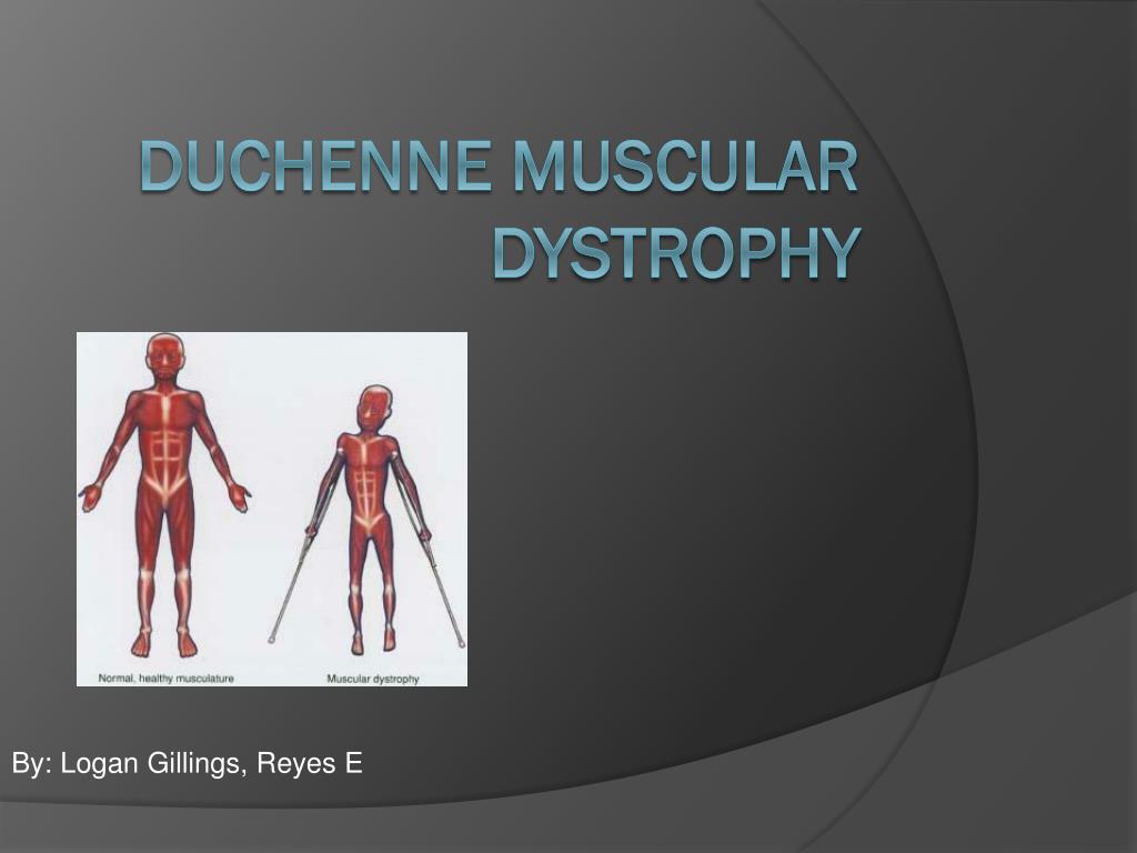 PPT - Duchenne Muscular dystrophy PowerPoint Presentation, free ...