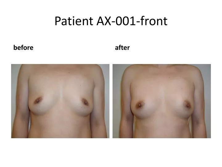 patient ax 001 front