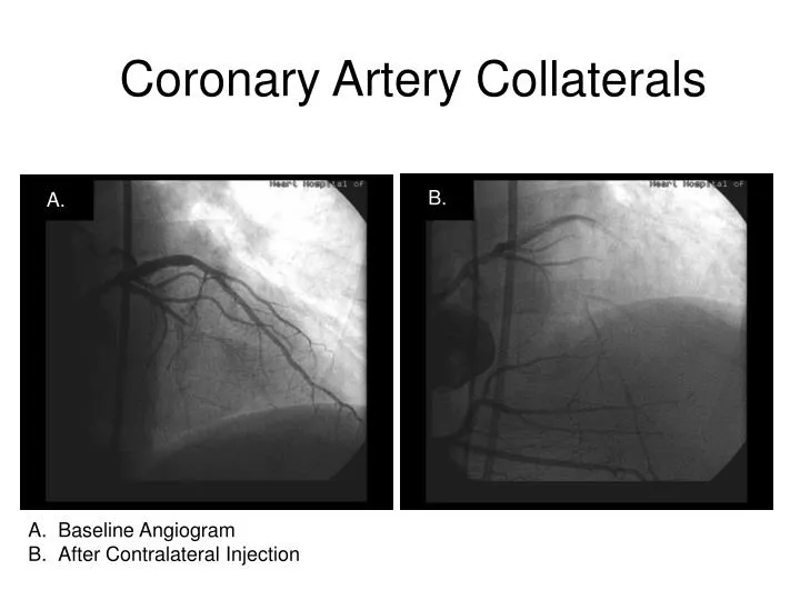 coronary artery collaterals