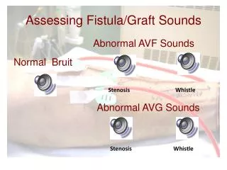 Assessing Fistula/Graft Sounds