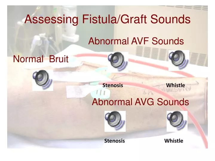 assessing fistula graft sounds