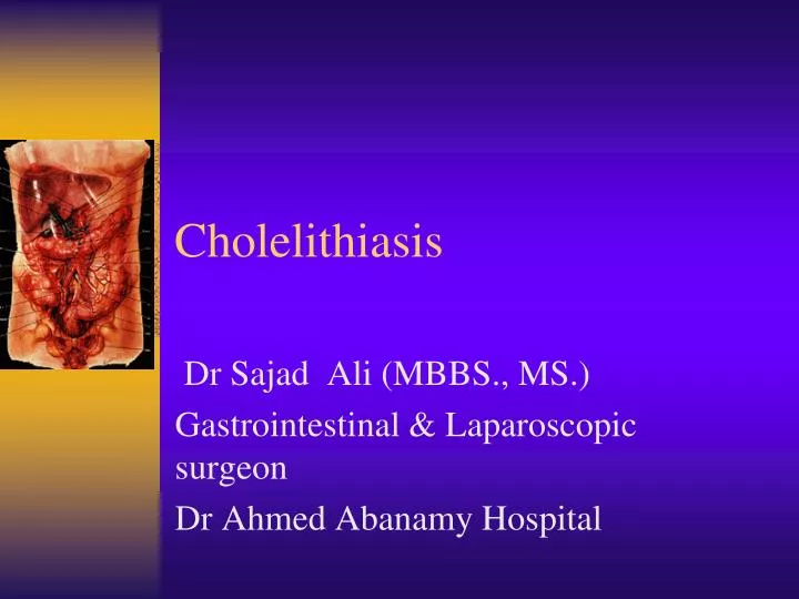 cholelithiasis