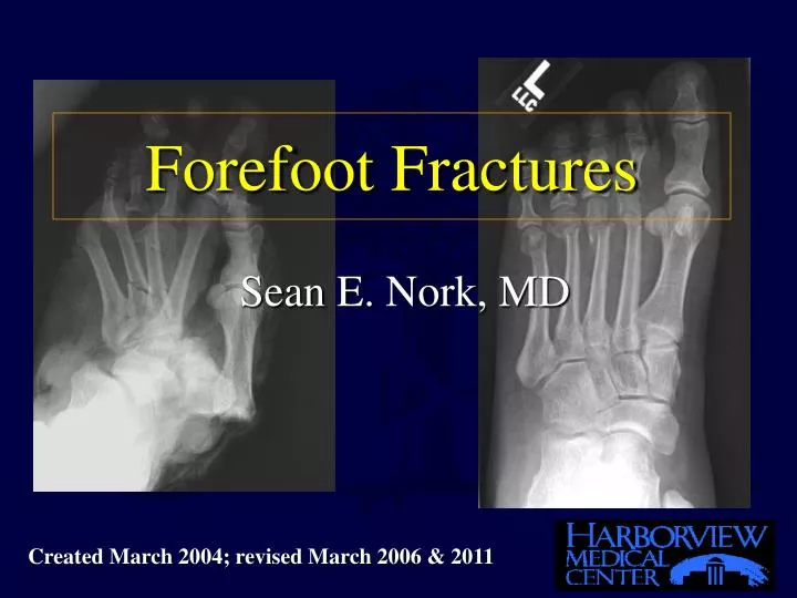 forefoot fractures