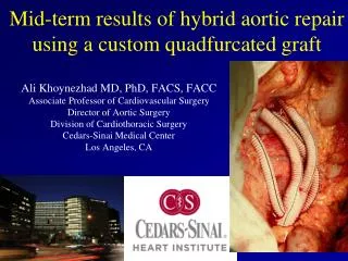 Mid-term results of hybrid aortic repair using a custom quadfurcated graft