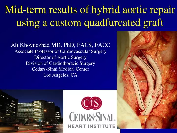 mid term results of hybrid aortic repair using a custom quadfurcated graft