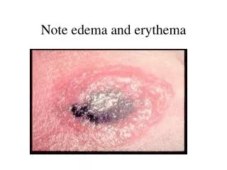 Note edema and erythema
