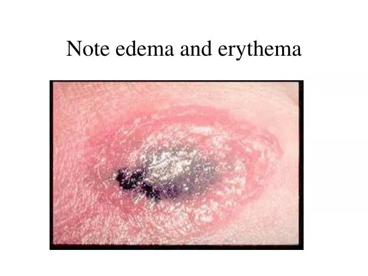 note edema and erythema