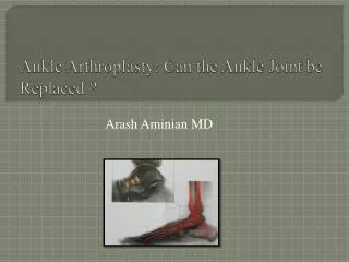 Ankle Arthroplasty : Can the Ankle Joint be Replaced ?