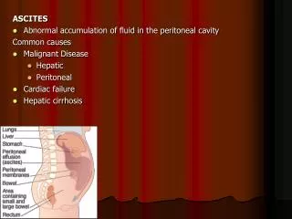 ASCITES Abnormal accumulation of fluid in the peritoneal cavity Common causes Malignant Disease