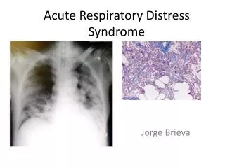 Acute Respiratory Distress Syndrome